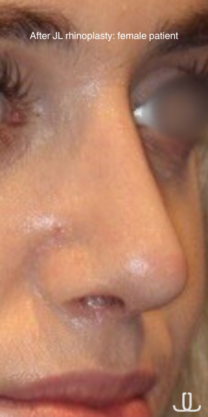 Rhinoplasty Before & After Patient #15860