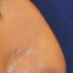 Rhinoplasty Before & After Patient #15860