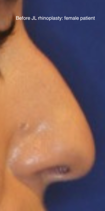 Rhinoplasty Before & After Patient #15860