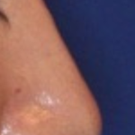 Rhinoplasty Before & After Patient #15860