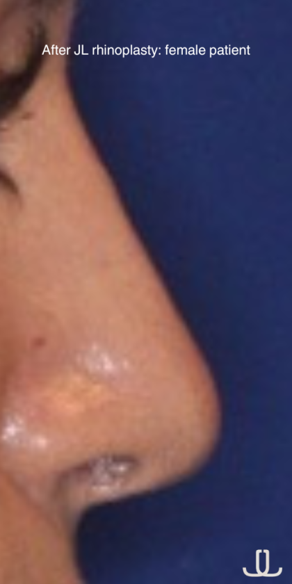 Rhinoplasty Before & After Patient #15860