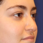 Rhinoplasty Before & After Patient #13814