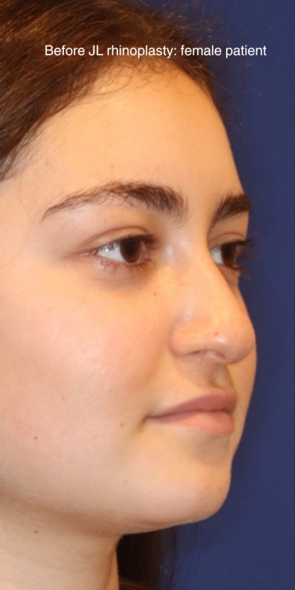 Rhinoplasty Before & After Patient #13814