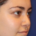 Rhinoplasty Before & After Patient #13814