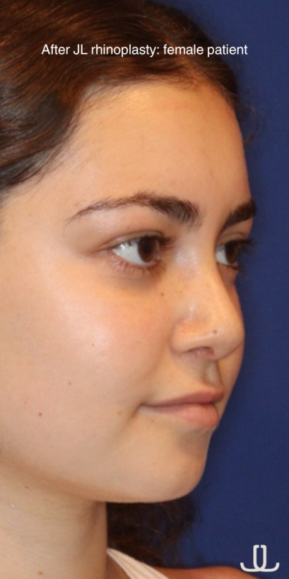 Rhinoplasty Before & After Patient #13814