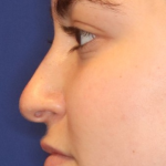 Rhinoplasty Before & After Patient #13814