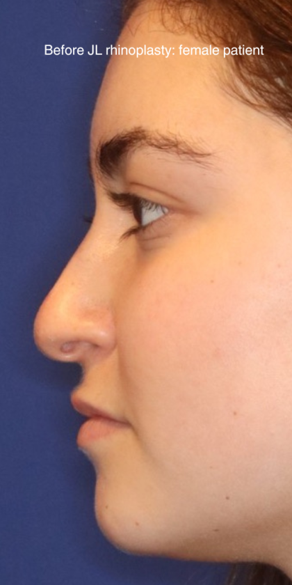 Rhinoplasty Before & After Patient #13814