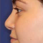 Rhinoplasty Before & After Patient #13814