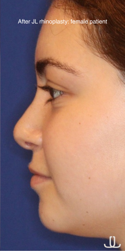 Rhinoplasty Before & After Patient #13814