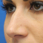 Rhinoplasty Before & After Patient #13779