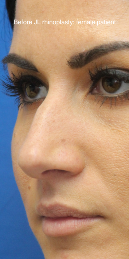 Rhinoplasty Before & After Patient #13779