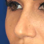 Rhinoplasty Before & After Patient #13779