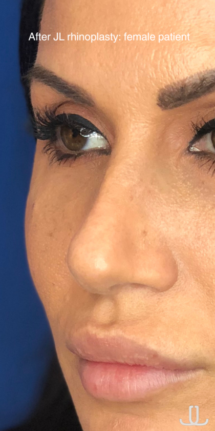 Rhinoplasty Before & After Patient #13779