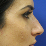 Rhinoplasty Before & After Patient #13779