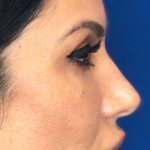 Rhinoplasty Before & After Patient #13779