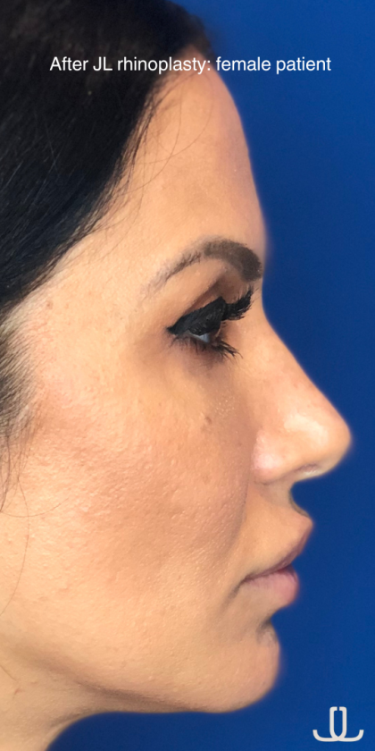 Rhinoplasty Before & After Patient #13779
