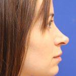 Rhinoplasty Before & After Patient #13812