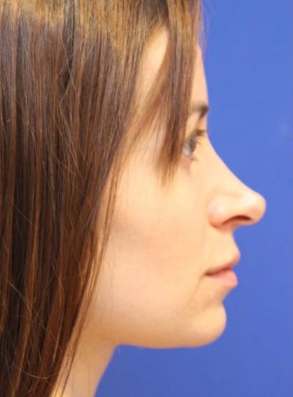 Rhinoplasty Before & After Patient #13812