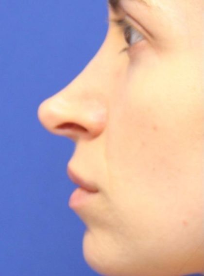 Rhinoplasty Before & After Patient #13812