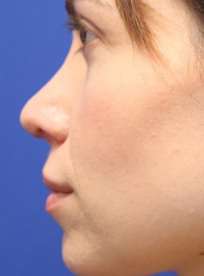 Rhinoplasty Before & After Patient #13812