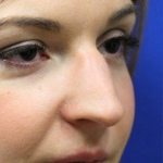 Rhinoplasty Before & After Patient #15184