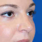 Rhinoplasty Before & After Patient #15184