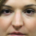 Rhinoplasty Before & After Patient #15184