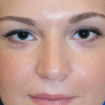 Rhinoplasty Before & After Patient #15184