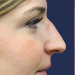 Rhinoplasty Before & After Patient #15184