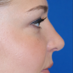 Rhinoplasty Before & After Patient #15184