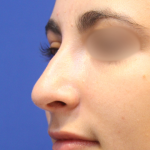Rhinoplasty Before & After Patient #15186