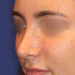 Rhinoplasty Before & After Patient #15186