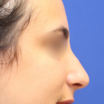 Rhinoplasty Before & After Patient #15186