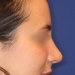 Rhinoplasty Before & After Patient #15186