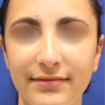 Rhinoplasty Before & After Patient #15186