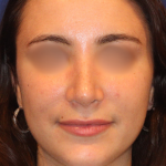 Rhinoplasty Before & After Patient #15186