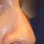 Rhinoplasty Before & After Patient #15187