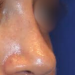 Rhinoplasty Before & After Patient #15187