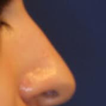 Rhinoplasty Before & After Patient #15187