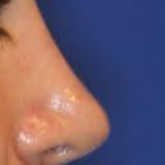 Rhinoplasty Before & After Patient #15187