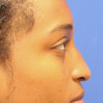Rhinoplasty Before & After Patient #13767