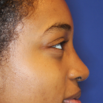 Rhinoplasty Before & After Patient #13767