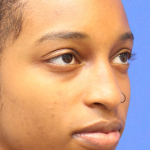 Rhinoplasty Before & After Patient #13767