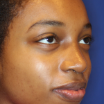 Rhinoplasty Before & After Patient #13767