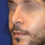 Revison Rhinoplasty Before & After Patient #13790