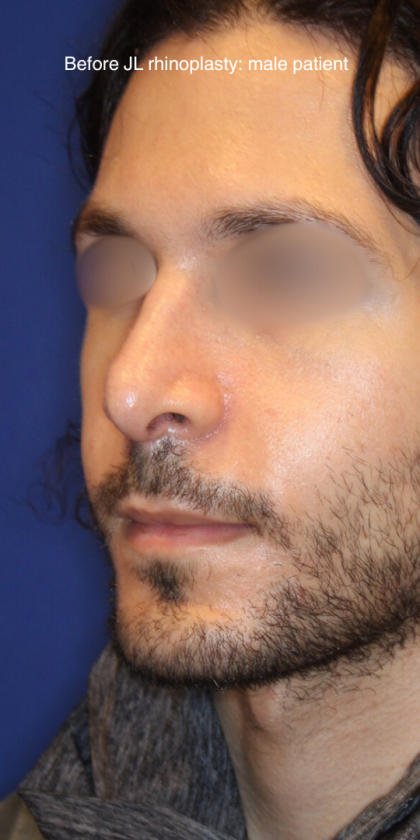 Revison Rhinoplasty Before & After Patient #13790
