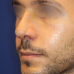 Revison Rhinoplasty Before & After Patient #13790