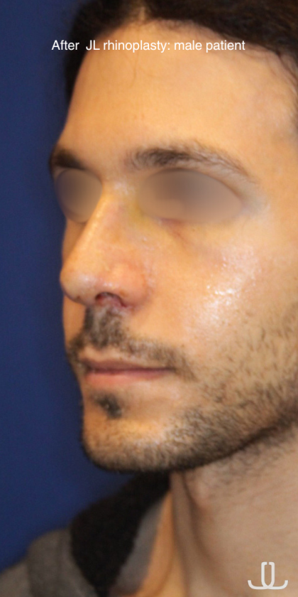Revison Rhinoplasty Before & After Patient #13790