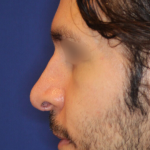 Revison Rhinoplasty Before & After Patient #13790
