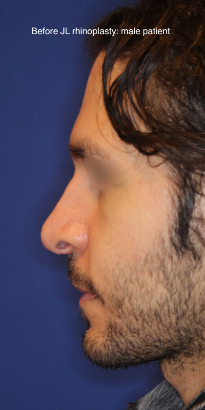 Revison Rhinoplasty Before & After Patient #13790